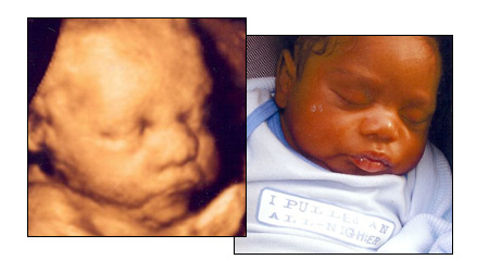 3D ULTRASOUNDS